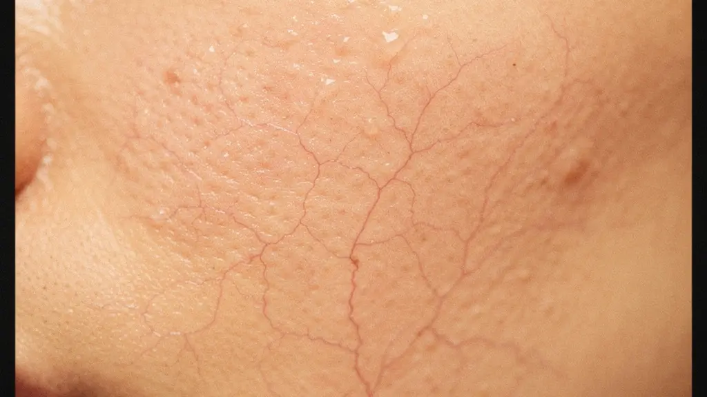 Comparaison visuelle de l'effet de la chaleur intense sur une peau présentant de la couperose, montrant l'aggravation des rougeurs.